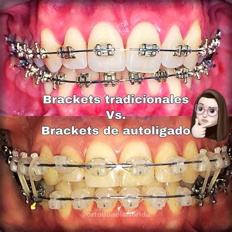 diferencia entre brackets y ligas